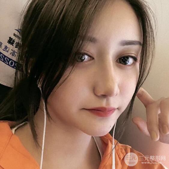 廣州名韓醫(yī)療美容卓敬錫“隆鼻整形+自體脂肪填充全臉”案例分享，整完有點(diǎn)像景甜