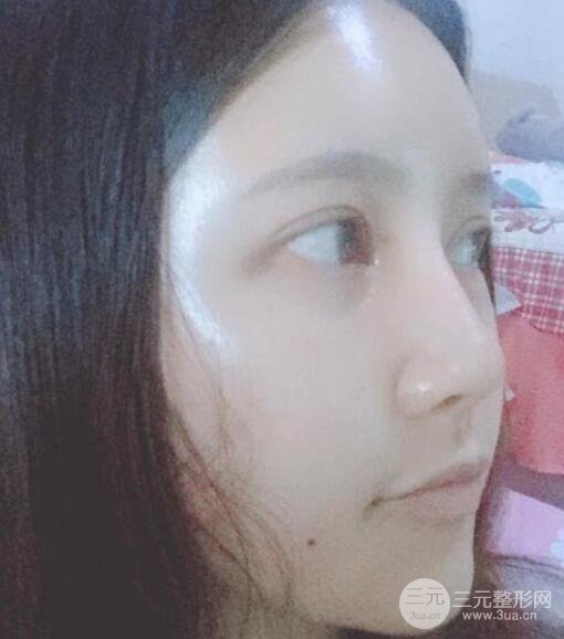 宜昌美岸醫(yī)療美容李英華自體脂肪面部填充怎么樣？真人日記曝光