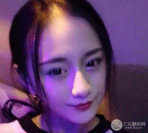 三亞三仁醫(yī)療美容于德印全切雙眼皮+開眼角一個月恢復(fù)圖來辣