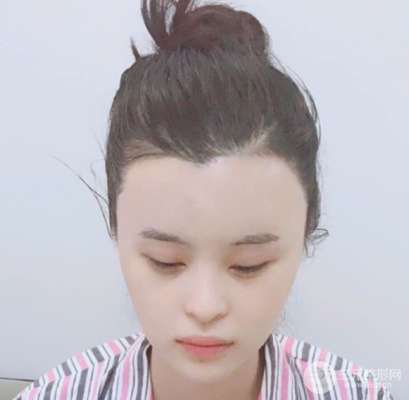 自體脂肪填充一個(gè)月真實(shí)恢復(fù)圖片，恢復(fù)后連閨蜜都驚艷辣