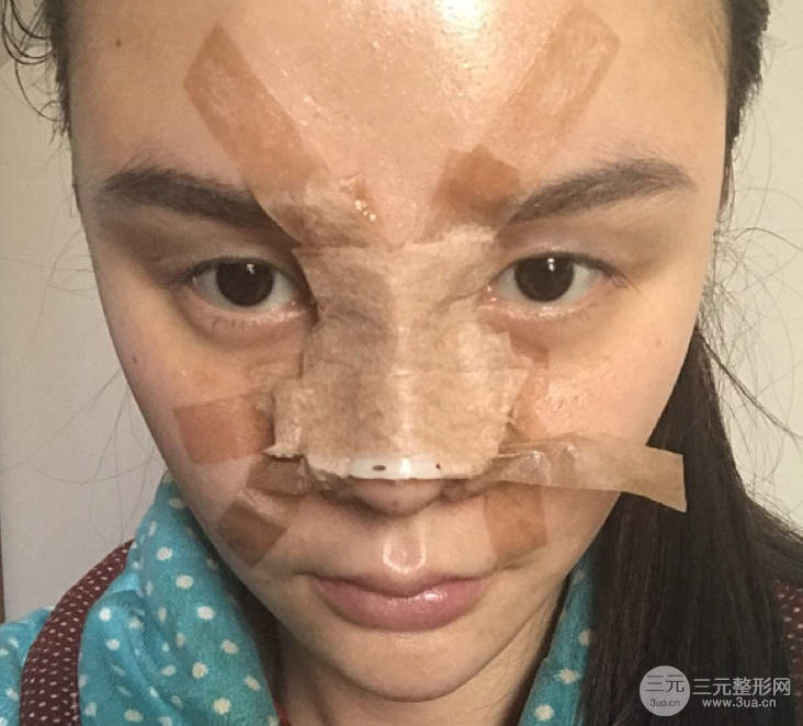 隆鼻整形三個月記錄，恢復后立體度不輸外國人
