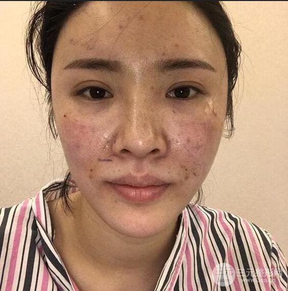 銀川崔大夫博士麗朱杰自體脂肪豐面頰恢復記錄附對比圖片