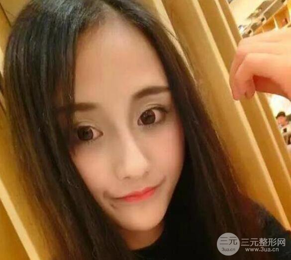 三亞三仁醫(yī)療美容于德印全切雙眼皮+開眼角一個月恢復(fù)圖來辣