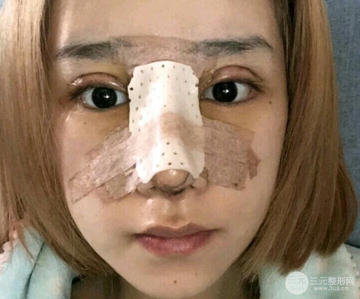 雙眼皮多項整形和隆鼻整形果圖
