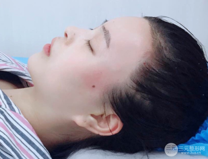自體脂肪填充一個(gè)月真實(shí)恢復(fù)圖片，恢復(fù)后連閨蜜都驚艷辣