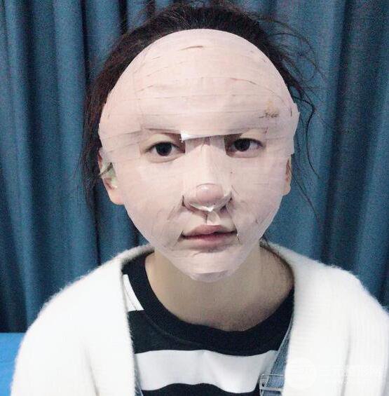 廣州名韓醫(yī)療美容卓敬錫“隆鼻整形+自體脂肪填充全臉”案例分享，整完有點(diǎn)像景甜