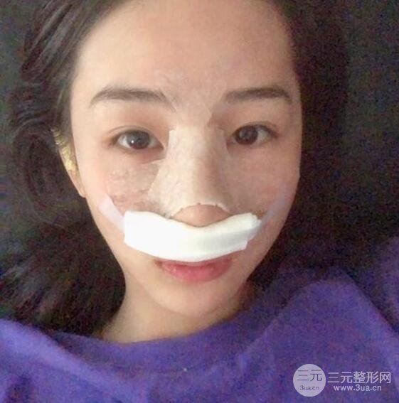 洛陽愛尚醫(yī)療美容王廷金隆鼻整形果圖，恢復(fù)后有點像張鈞甯