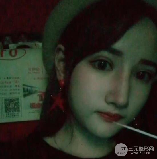 去下頜角+顴骨內(nèi)推手術(shù)三個(gè)月記錄，看大臉妹如何逆襲