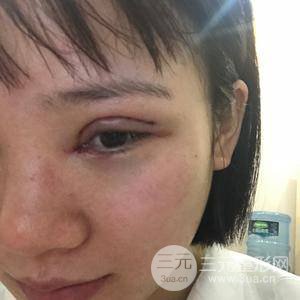 全切雙眼皮半個月恢復全記錄