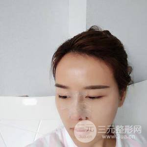 自體脂肪面部填充恢復自然果圖