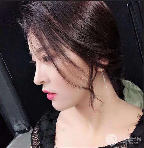 珠海陸達(dá)彭劍隆鼻整形術(shù)前術(shù)后對(duì)比