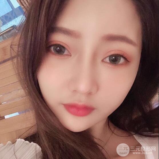 只是做了隆鼻整形改變居然辣么大，快來(lái)看看我的隆鼻整形恢復(fù)日記叭