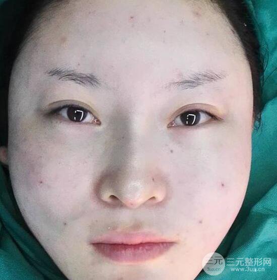 自體脂肪面部填充果怎么樣？對比反饋