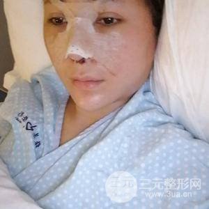 進口假體+肋軟骨墊鼻尖三個月果恢復(fù)對比圖