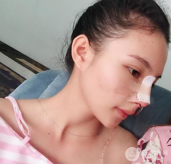 妹子做了隆鼻整形后竟變混血臉，來看看像baby還是娜扎