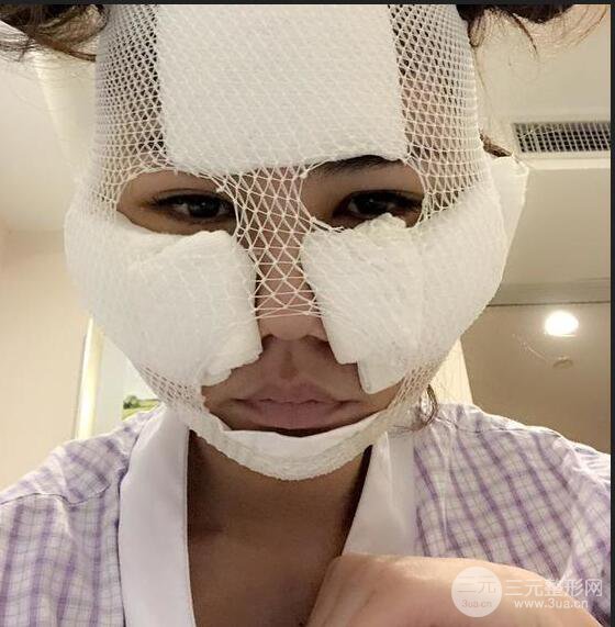 泉州億星閔英俊磨骨恢復圖分享