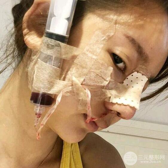 只是做了隆鼻整形改變居然辣么大，快來(lái)看看我的隆鼻整形恢復(fù)日記叭