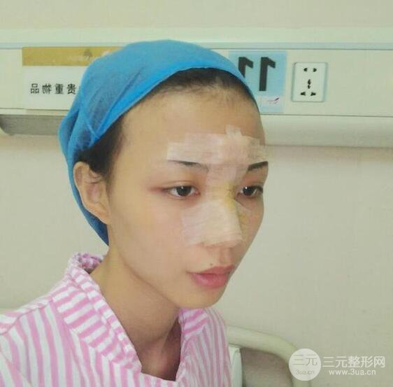 凸嘴先別急著正頜，做個隆鼻整形會更美