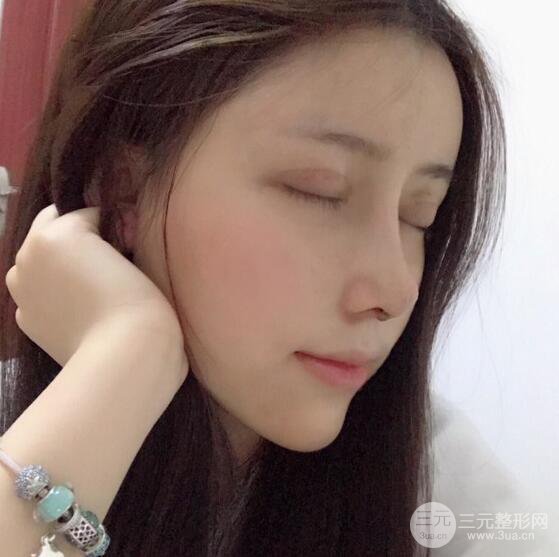 膨體隆鼻和雙眼皮一起做的果怎么樣？