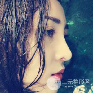 進口假體+肋軟骨墊鼻尖三個月果恢復(fù)對比圖