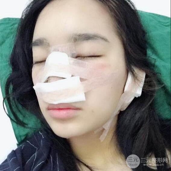 隆鼻整形術前術后對比照曝光，附經驗分享及心得體會