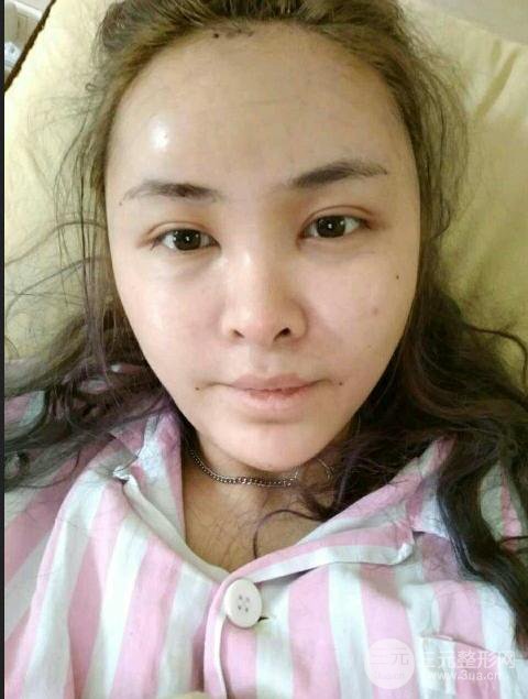 廣州名韓醫(yī)療美容彭麗霞自體脂肪填充面部反饋