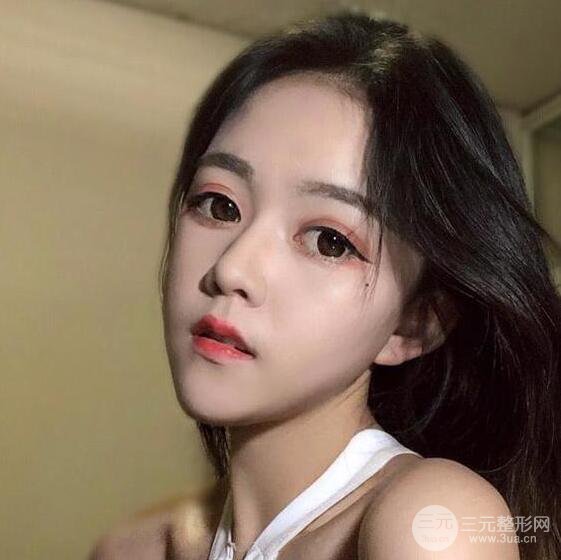 泉州億星醫(yī)療美容閔英俊切開雙眼皮果對比