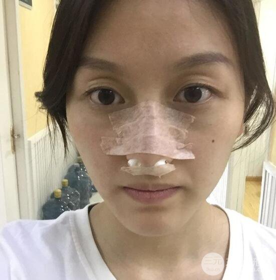 做了“埋埋蛋白線.提升+隆鼻整形”，恢復(fù)后老公說很沒有降低風(fēng)險(xiǎn)感