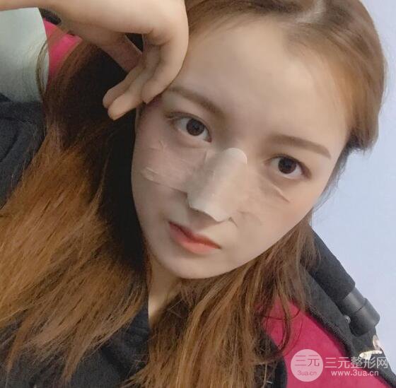 隆鼻整形多久恢復(fù)自然，模特公布隆鼻整形恢復(fù)記錄附照片