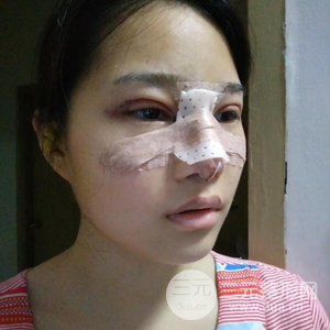 雙眼皮多項(xiàng)整形隆鼻整形一起做怎么樣？真人曝光果對(duì)比圖