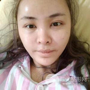 自體脂肪面部填充三個月恢復過程圖