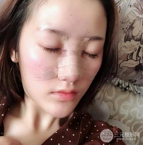 膨體隆鼻三十天恢復(fù)記錄，術(shù)前術(shù)后對比圖片曝光
