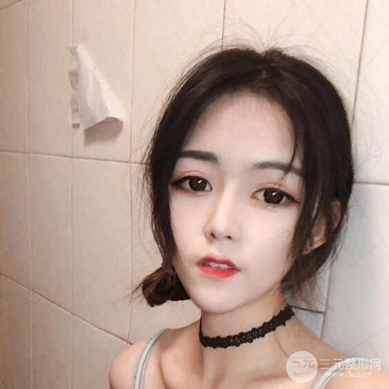 泉州億星醫(yī)療美容閔英俊切開雙眼皮果對比