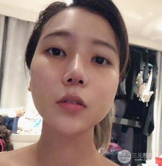 揚州艾菲斯醫(yī)療美容張健隆鼻整形恢復記錄