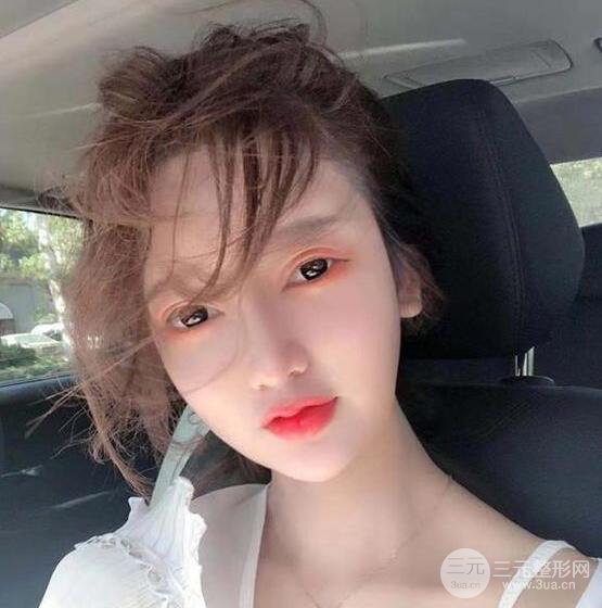 只是做了隆鼻整形改變居然辣么大，快來(lái)看看我的隆鼻整形恢復(fù)日記叭