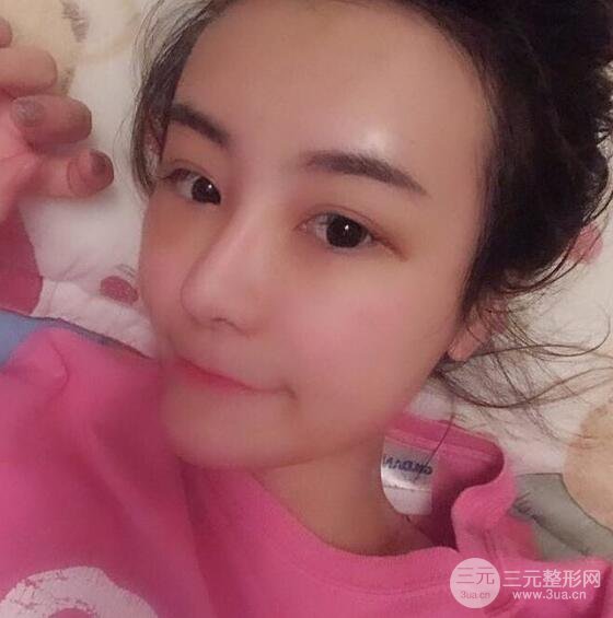 做了自體脂肪填充全臉，別人都以為我老公較為有錢