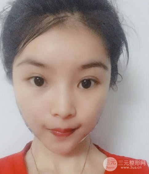 埋埋蛋白線.提升恢復(fù)圖，原來(lái)小V臉不一定要磨骨