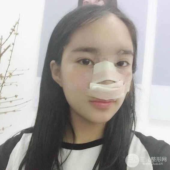 隆鼻整形術前術后對比照曝光，附經驗分享及心得體會