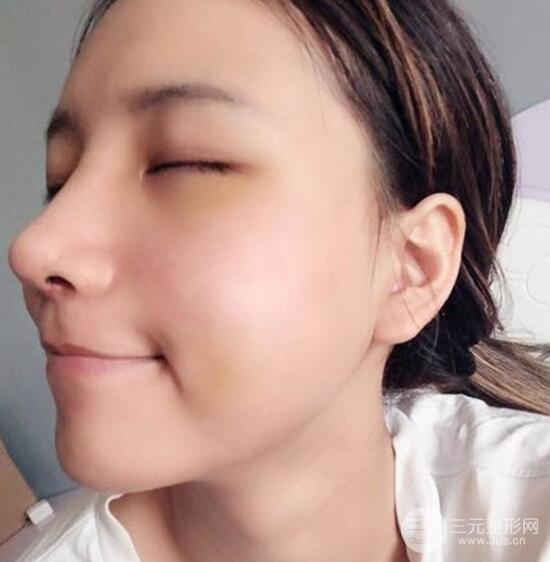 揚州艾菲斯醫(yī)療美容張健隆鼻整形恢復記錄