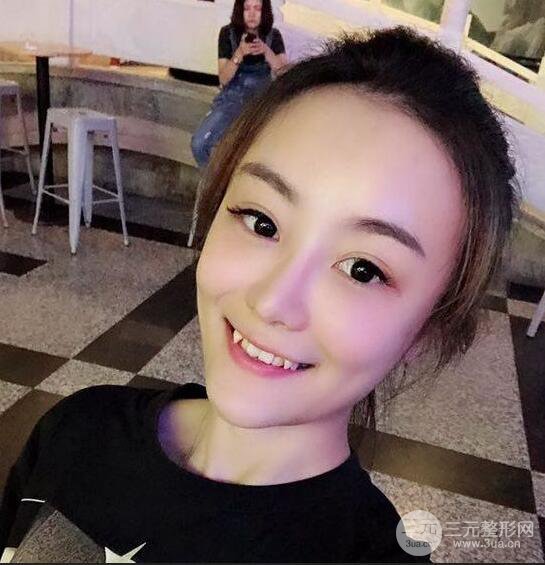 做了自體脂肪填充全臉，別人都以為我老公較為有錢