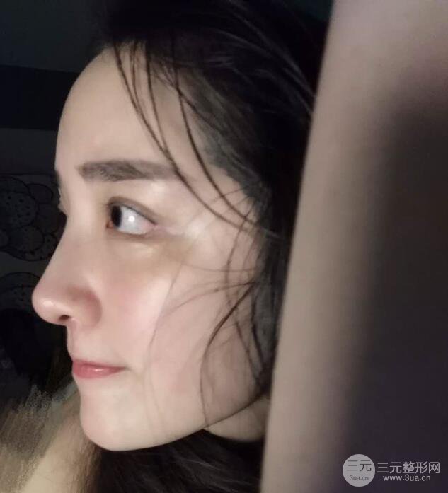東莞寶格麗韋文奇隆鼻整形果圖分享，對(duì)比曝光