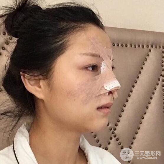 肋軟骨隆鼻六十天恢復記錄圖