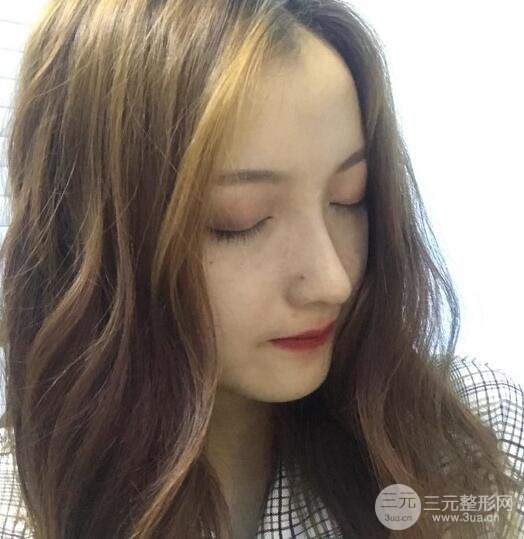隆鼻整形多久恢復(fù)自然，模特公布隆鼻整形恢復(fù)記錄附照片