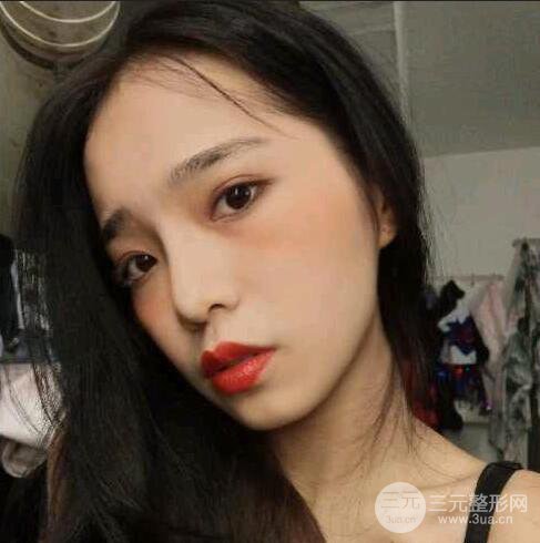 隆鼻整形術前術后對比照曝光，附經驗分享及心得體會