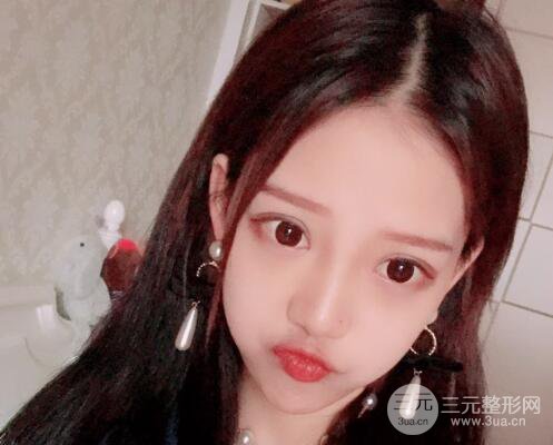 割雙眼皮多久會(huì)恢復(fù)