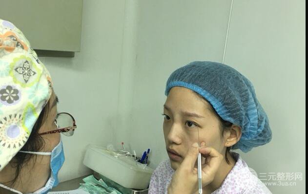 割雙眼皮多久會(huì)恢復(fù)