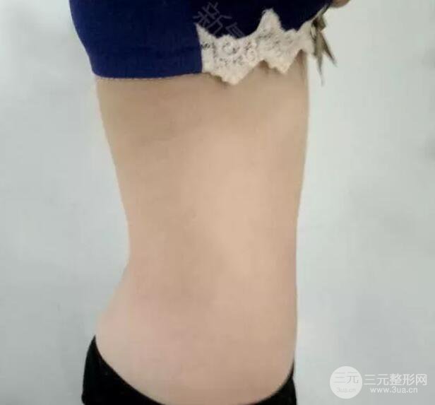腹腰吸脂三個(gè)月圖片