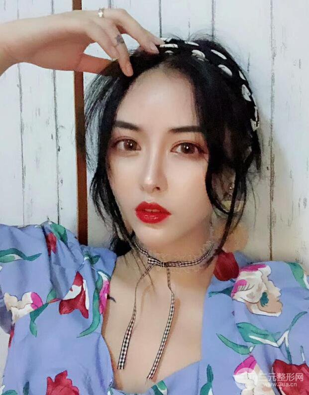 廣州名韓醫(yī)療美容彭麗霞自體脂肪填充面部反饋