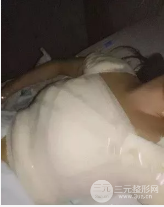 假體隆胸恢復(fù)期3個月圖片，真人日記曝光