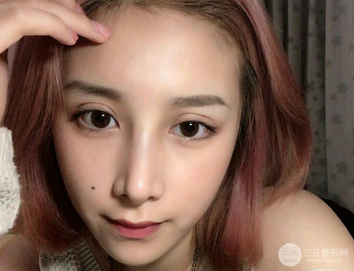 雙眼皮多項整形和隆鼻整形果圖